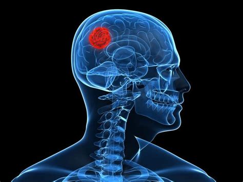 Tumor En El Cerebro Qué Es Causas Síntomas Y Mucho Más