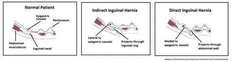 The Inguinal Canal Boundaries Contents TeachMeAnatomy