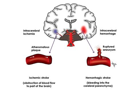 Cerebrovascular Accident A Stroke Of Misfortune