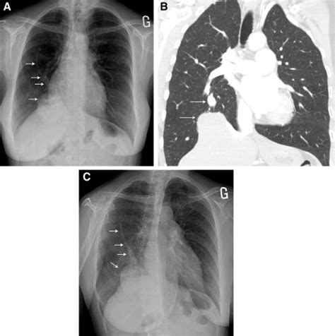 A Chest X Ray Antero Posterior Projection Showing A Hypoplastic