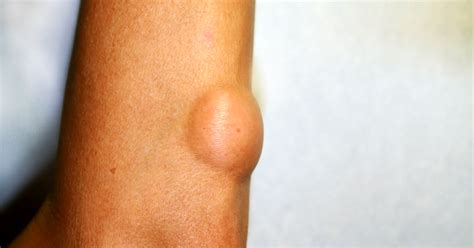 Swollen Armpits Lymph Nodes