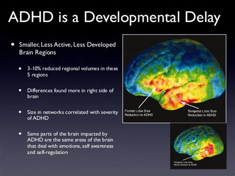 Adhd And Brain Structure The Disorder Affects Teens Memories Later In