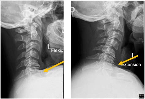 X Ray Cervical Spine Dynamic Lateral View Showing Stable Cervical