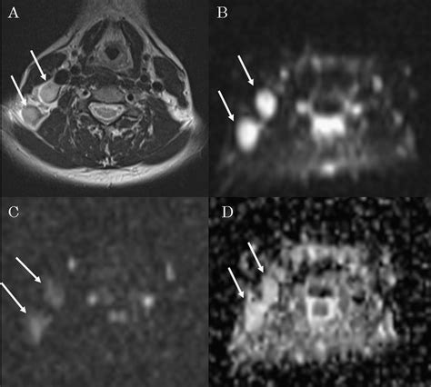 Diffusion Weighted Mri In Cervical Lymph Nodes Differentiation Between