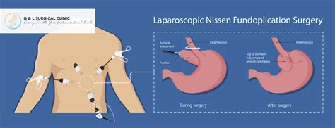 Laparoscopic Hiatal Hernia Surgery Nissen Fundoplication In Singapore