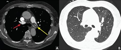 chest ct require contrast enhancement cleveland clinic