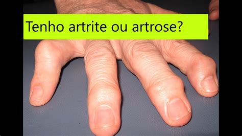 Como diferenciar artrose de artrite nas mãos guia simples e completo