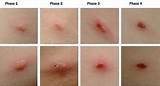 Images of Shingles Recovery Period
