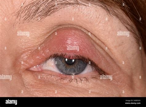 MODEL RELEASED Chalazion Cyst On An Eyelid In A Year Old Woman