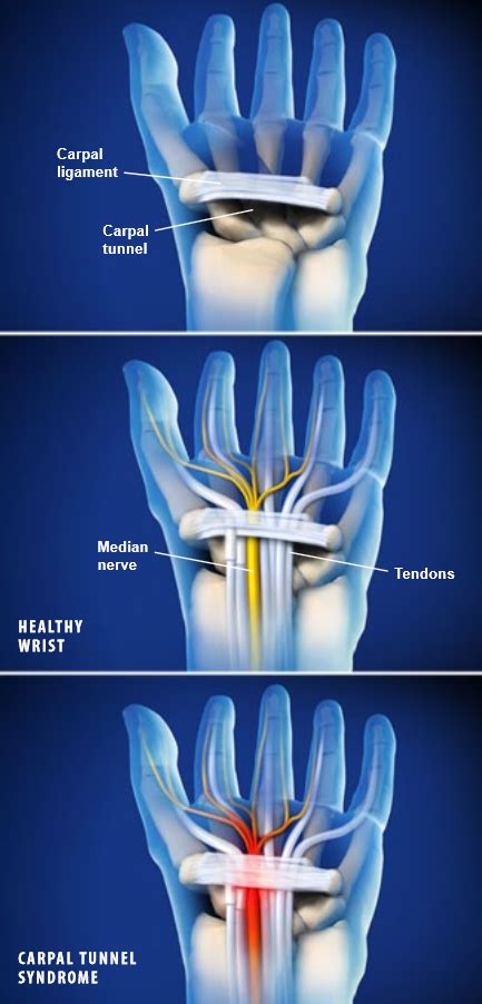 The median nerve, which controls sensation and movement in the thumb and first three fingers, runs through this passageway along with tendons to the fingers and thumb. Carpal Tunnel Syndrome | Central Coast Orthopedic Medical ...