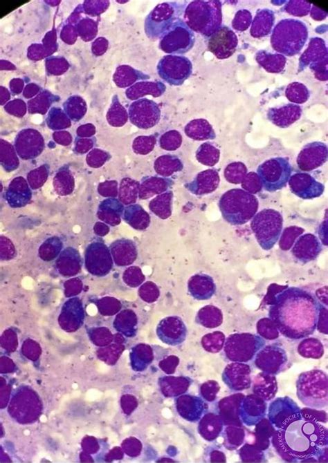 T Acute Lymphoblastic Leukemia With Plasmacytosis 1