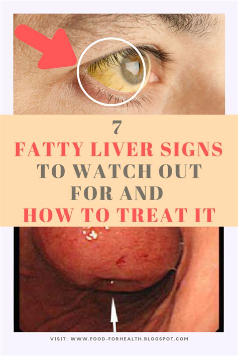 7 Fatty Liver Signs To Watch Out For And How To Treat It Health