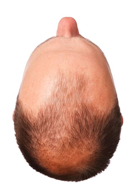Male Pattern Baldness Stock Photo Image 11935810