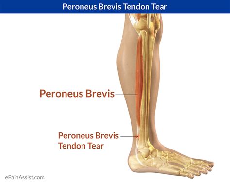 Peroneus Brevis Tendon Tearsymptomscausestreatmentexercisessports