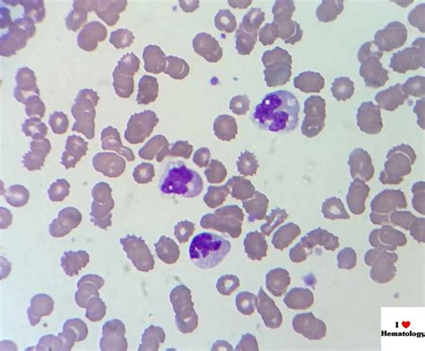 Veterinary Hematology Dextervet Vacuolated Monocytes Septicemia