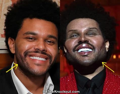 The Weeknd Before And After Plastic Surgery Gregg Hic