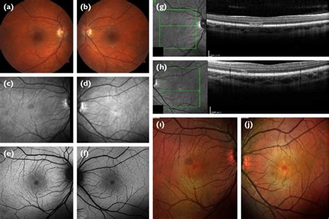 Multimodal Imaging Of Both Eyes A Color Fundus Photograph Cfp Of