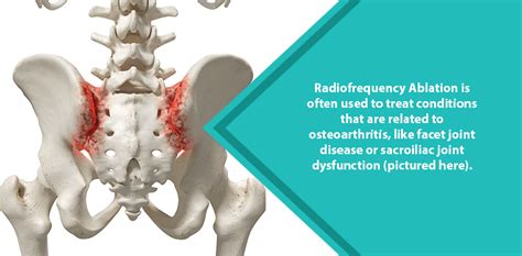 What Is Radiofrequency Ablation For Nerve Pain Nj Spine And Ortho