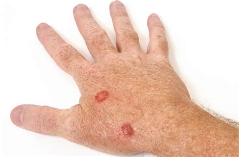 Types Of Skin Cancer On Hands