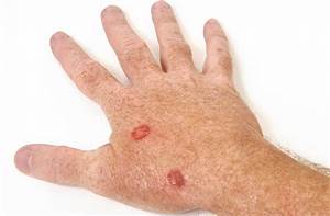 skin-cancer - Arora Hand Surgery Skin Cancer  