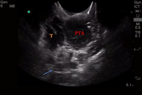 What Is That Hot Potato Voice Pocus For The Pta — Brown Emergency Medicine