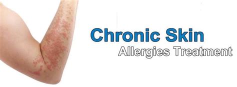 Skin Allergy Treatment In The City Skin Allergy Is A