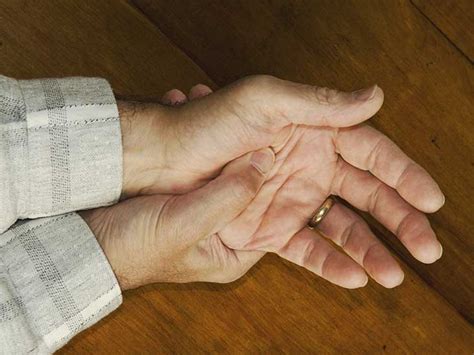 Psoriatic Arthritis Mutilans What Is It