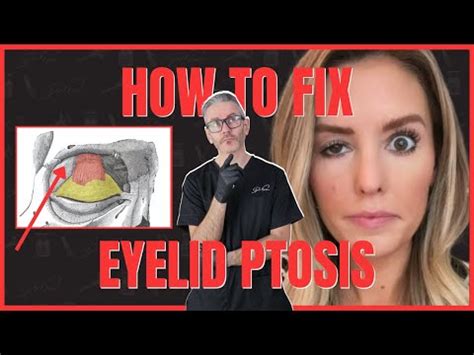 3 Ways To Fix Eyelid Ptosis After Botox YouTube