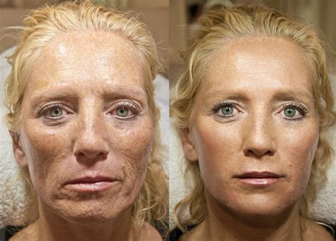 Lower Face Filler Before And After
