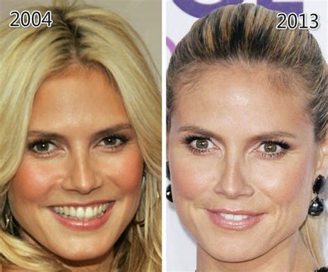 Heidi Klum Before And After Plastic Surgery Celebrity Plastic