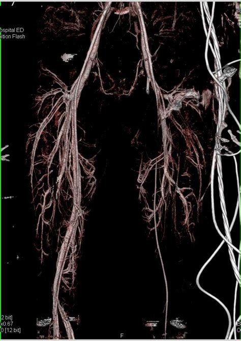 Vascular Injury Left Femoral Artery Vascular Case Studies Ctisus Ct