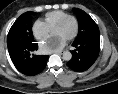 Atrial Myxoma Presenting As Abdominal Pain An Unusual Association