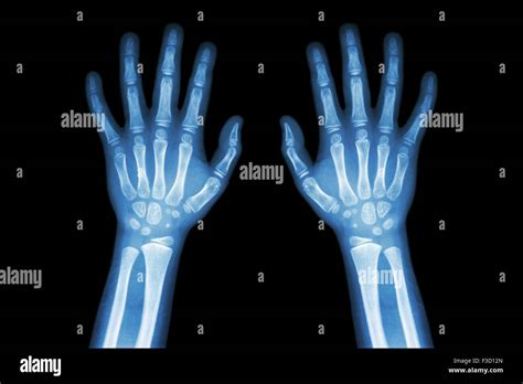 Child Hand X Ray Stockfotos Und Bilder Kaufen Alamy