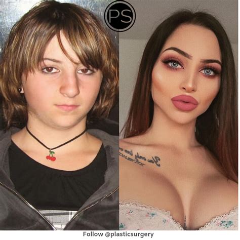 Pin On Plastic Surgery Before And After