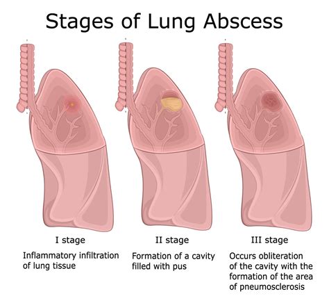 Lung Abscess Symptoms Causes Diagnosis And Treatment
