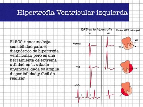 Hipertrofia Ventricular