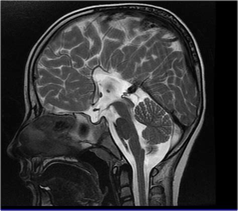 Sagittal Brain Mri Of Index Case Mri Depicts Complete Agenesis Of