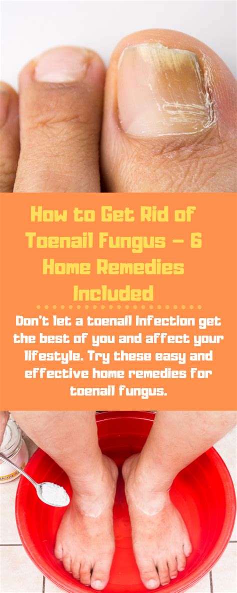How To Get Rid Of Toenail Fungus 6 Home Remedies Included Toenail