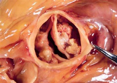 Calcified Bicuspid Aortic Valve Surgical View Download Scientific