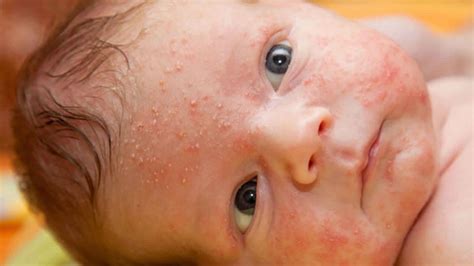 Baby Acne Causes Signs Symptoms Diagnosis Treatment And Prognosis