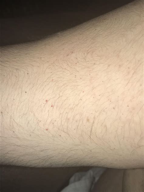 Petechiaeblood Spots Have Been Appearing On My Arms Increasingly Over
