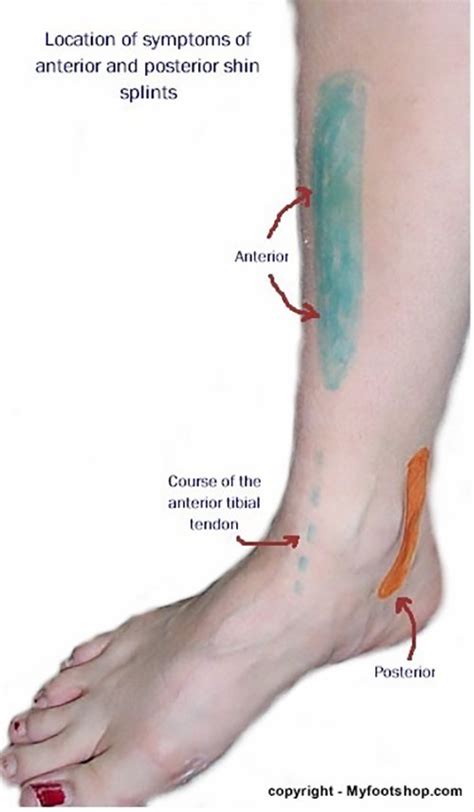 Shin Splints Causes Contributing Factors And Treatment Options