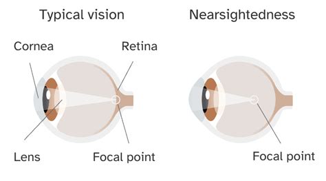Nearsightedness Genetics And More 23andme