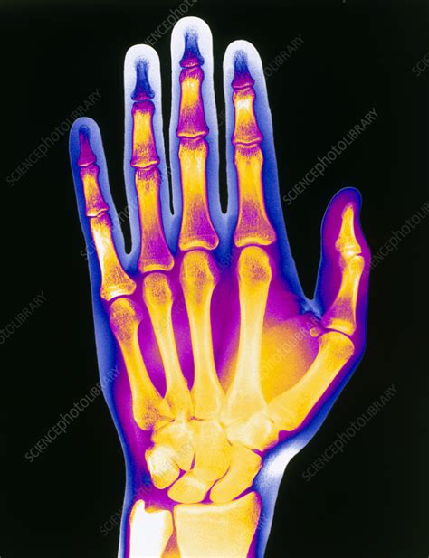 Coloured X Ray Of The Healthy Hand Of A Man Stock Image P1160275