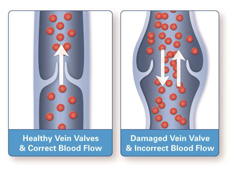 Vein And Vascular Treatment Vein And Vascular Care Clinic La Jolla Ca