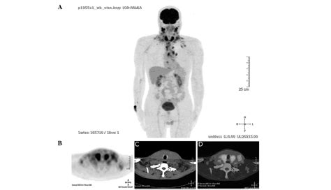 Anaplastic Thyroid Carcinoma With Diffuse Thoracic Skin Metastasis A