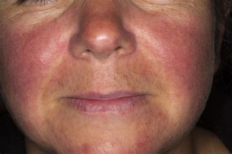 Lupus Rash On Face Pictures Medical Pictures And Imag
