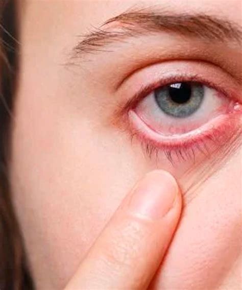Remedios Para Las Infecciones Oculares Eficaces Infecciones Oculares Infeccion En Los Ojos