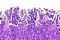 Micropapillary urothelial carcinoma - Libre Pathology
