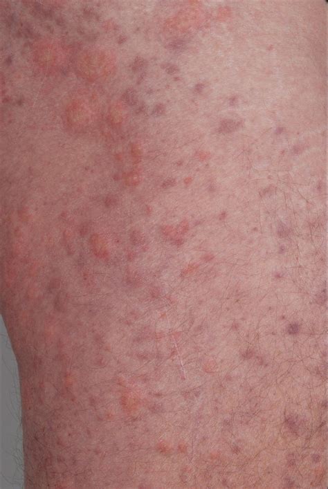 Urticarial Vasculitis Hypocomplementemic Urticarial Vasculitis